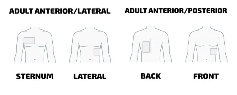 Optimum method for defibrillation Pad Placement - Intelesens